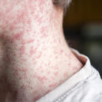 atlantisthemes - Measles outbreak investigation in Utah blocked by patient who refuses to talk