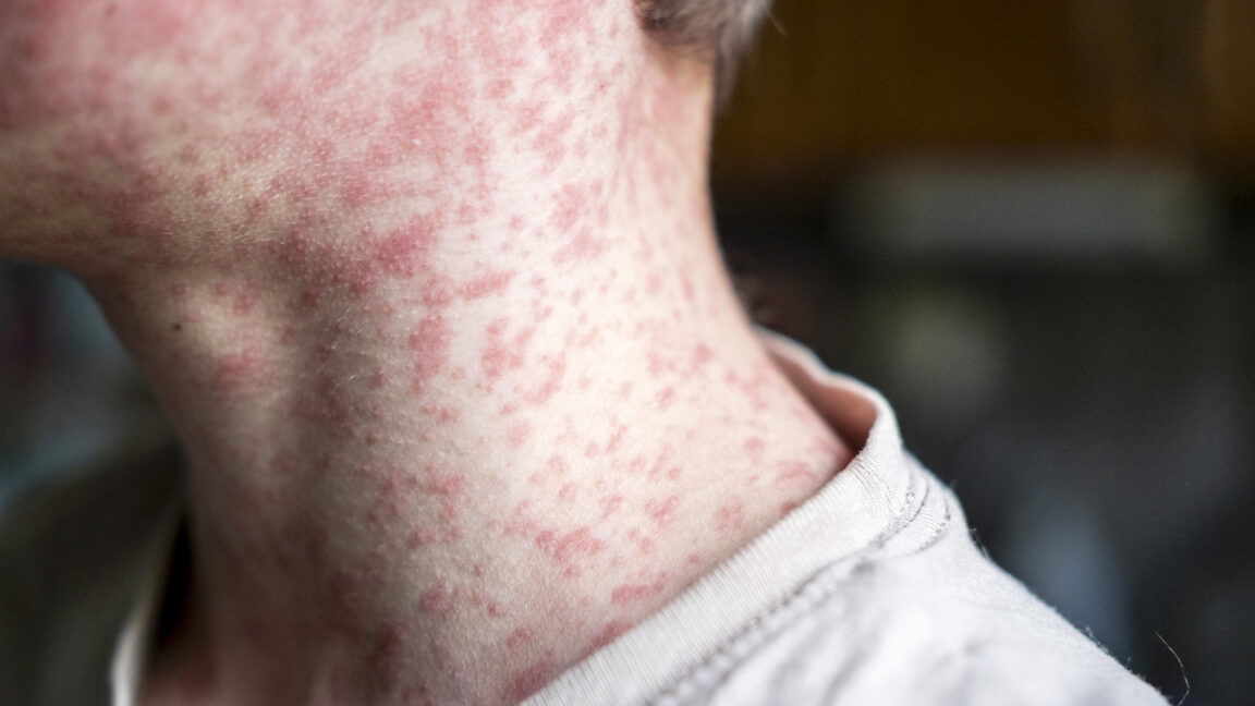 atlantisthemes - Measles outbreak investigation in Utah blocked by patient who refuses to talk